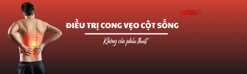 Cong vẹo cột sống